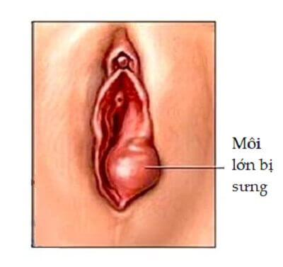 Môi lớn bị sưng 1 bên